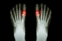 How Podiatrists Can Test for Gout