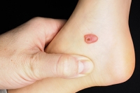 Causes and Duration of Foot Blood Blisters
